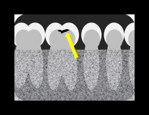 occlusal caries diagram