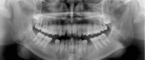 Caries Interpretation: Occlusal Caries Answers