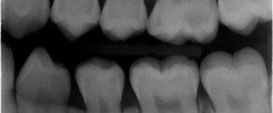 Caries Interpretation: Occlusal Caries Practice