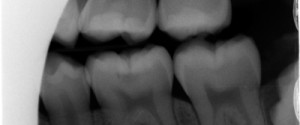 Caries Interpretation: Occlusal Caries