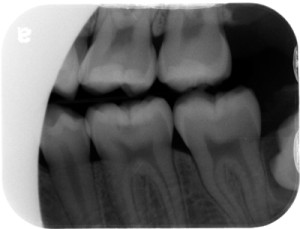 occlusal caries radiograph
