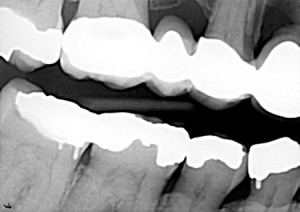 psuedo Mach effect digital radiograph