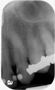 recurrent caries example