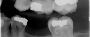 Caries Interpretation: Recurrent Caries Answers