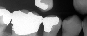 Caries Interpretation: Root Caries