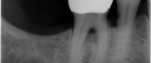 Caries Interpretation: Root Caries Practice