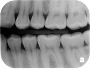 Caries Interpretation: Root Caries Answers – Dr. G's Toothpix