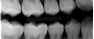 Find the Caries: April 2014 ANSWERS