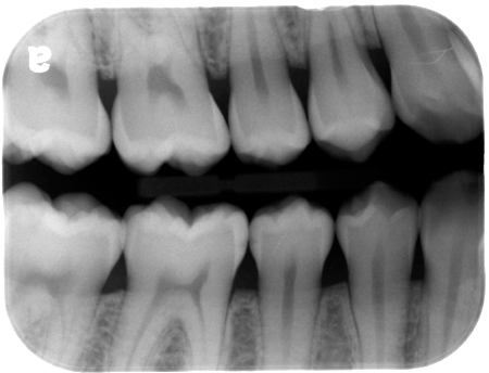 Find the Caries: April 2014 ANSWERS – Dr. G's Toothpix