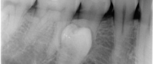 Case of the Week: Supernumerary teeth (Peridens)