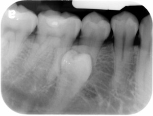 peridens periapical radiograph right