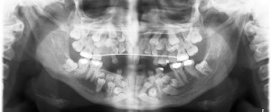 Case of the Week: Cleidocranial Dysplasia