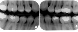 Find the Caries: May 2014 ANSWERS