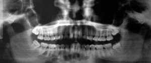 Case of the Week: Hyperparathyroidism with a Brown Tumor