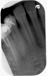 canine periapical radiograph lto June 2014