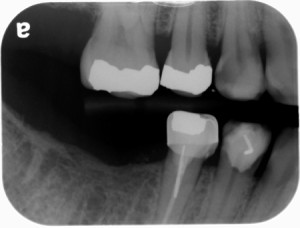 premolar bitewing radiograph lto June 2014