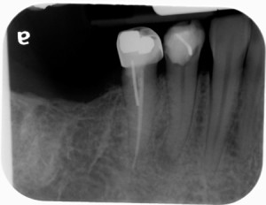 premolar periapical radiograph lto June 2014