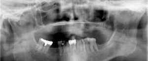 Case of the Week: Synovial Chondromatosis