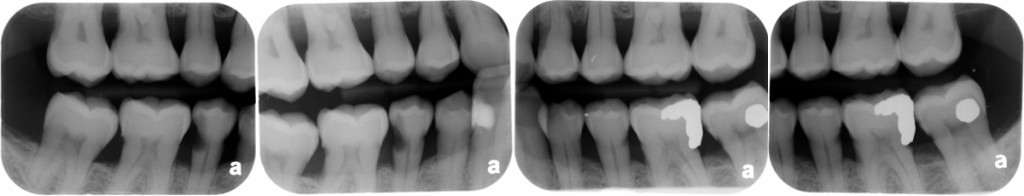 find the caries - July 2014b