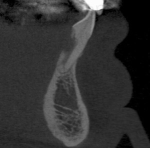 Sagittal CBCT view showing external resorption of the mandibular right central incisor (#25) from the palatal aspect of the root to the root canal space.