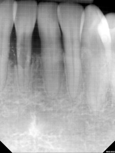 Periapical radiograph showing resorption of the mandibular right central incisor (#25) as an increased radiolucent area over the root.