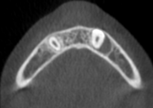 Axial view from CBCT scan showing the distal enlargement of the follicle around the root.