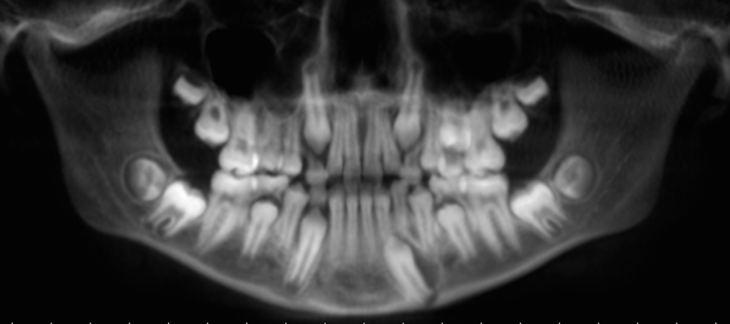 Reconstructed pantomograph from a CBCT scan.  Look at the distal aspect of the developing permanent mandibular left canine.