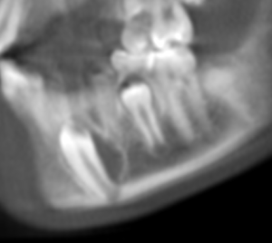 Rotated sagittal view from CBCT scan (5mm thickness) showing the radiolucent area is continuous with the follicle around the tooth.