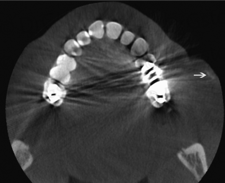 CBCT axial view showing osteoma cutis.