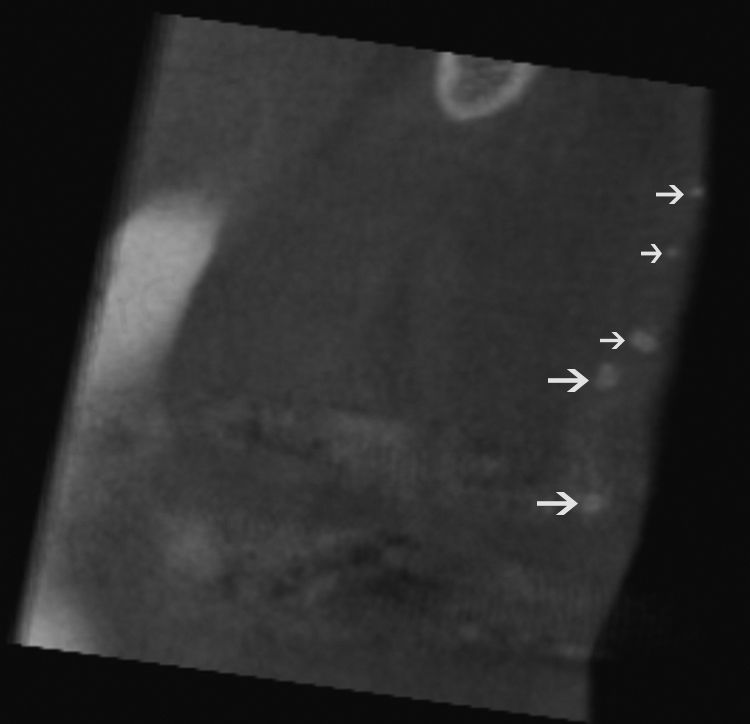 CBCT sagittal view showing multiple areas of osteoma cutis.