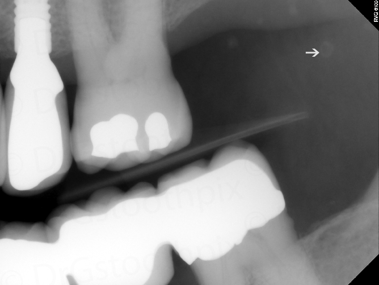 Bitewing radiograph showing punctate round radiopaque entity (arrow).