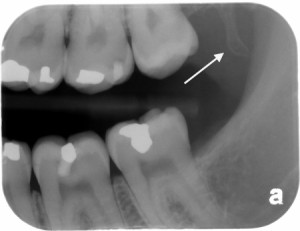 Bitewing radiograph showing the hamulus (arrow).