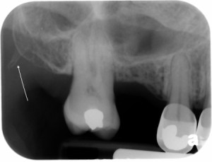 Periapical radiograph showing the hamulus (arrow).