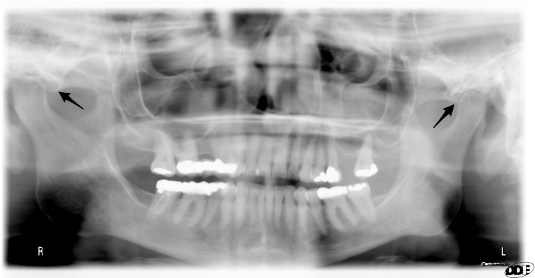 Anatomy Monday: Anterior Articular Eminence (Temporal Bone) – Dr. G's ...