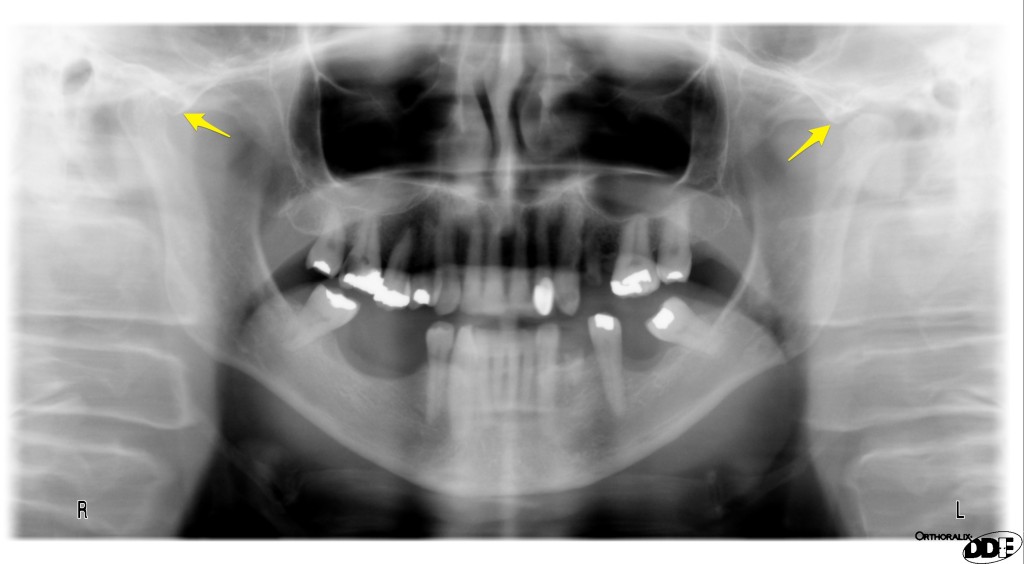 anterior articular eminence - pantomograph anatomy - drgstoothpix 2