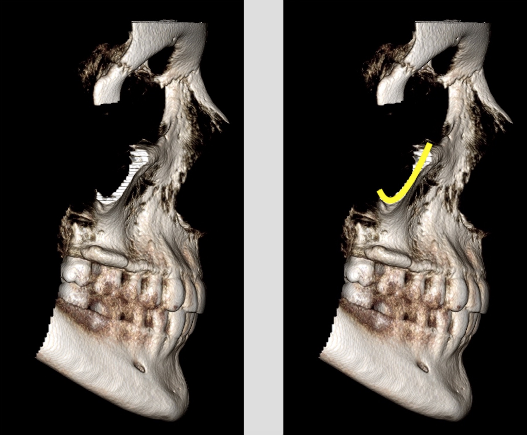 Anatomy Monday: Zygomatic Process of the Maxilla