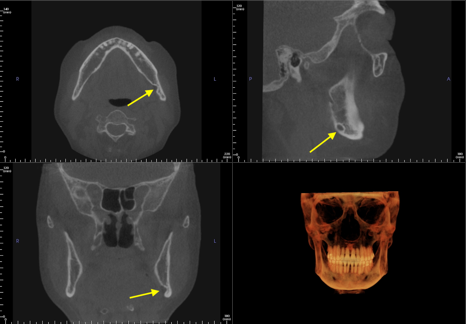 Case of the Week: Stafne Defect