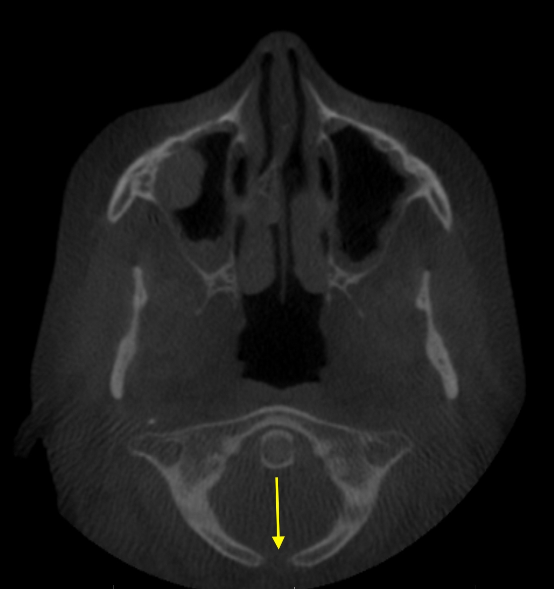 Case of the Week: Posterior Cleft of Cervical Vertebra 1 (C1 or Atlas)