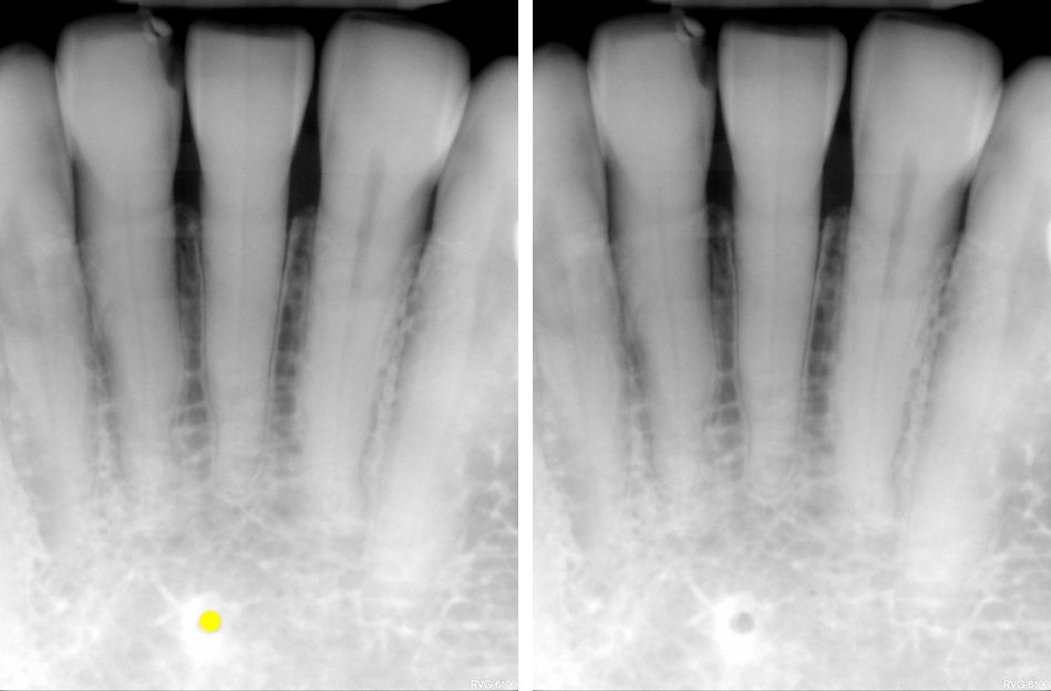 Anatomy Monday: Foramina on Intraoral Radiographs