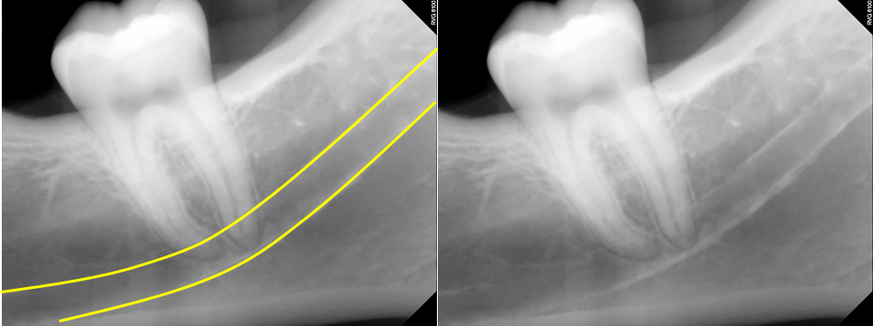 Anatomy Monday: Anatomy on Mandibular Periapical Radiographs