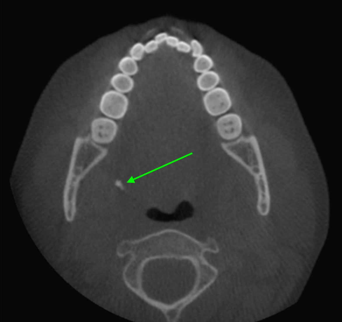 Case of the Week: Tonsiliths on CBCT