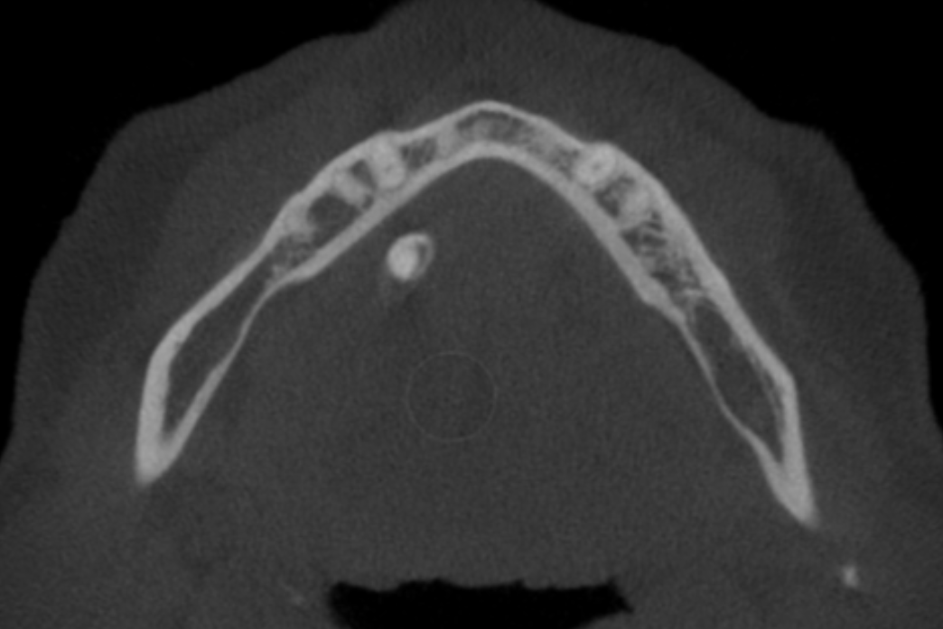 Case of the Week: Sialolith with layers (CBCT)