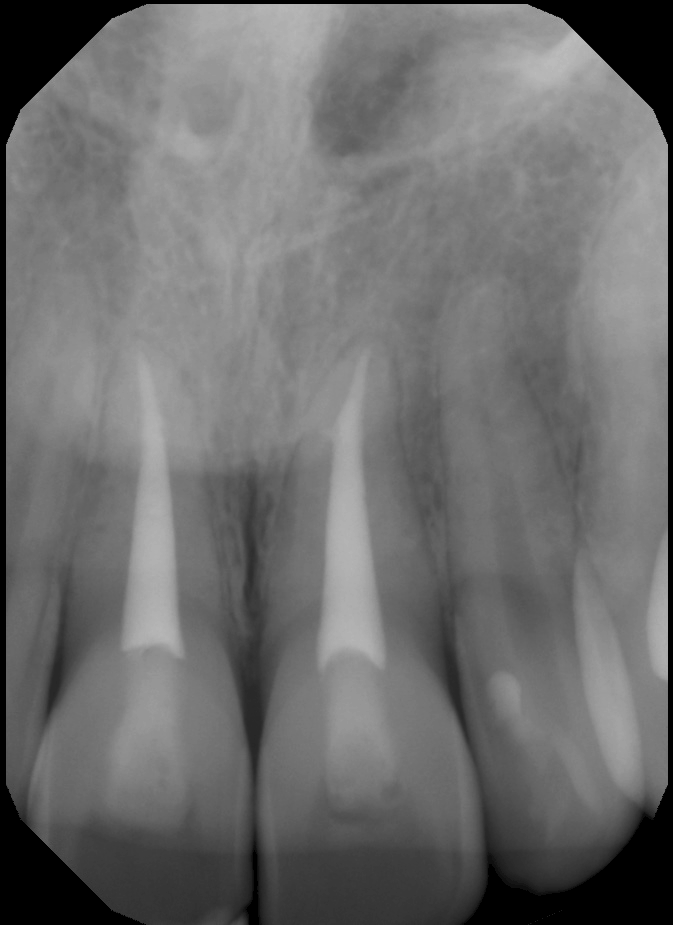 Anatomy is your friend: Maxillary Central Incisors Periapical Radiograph