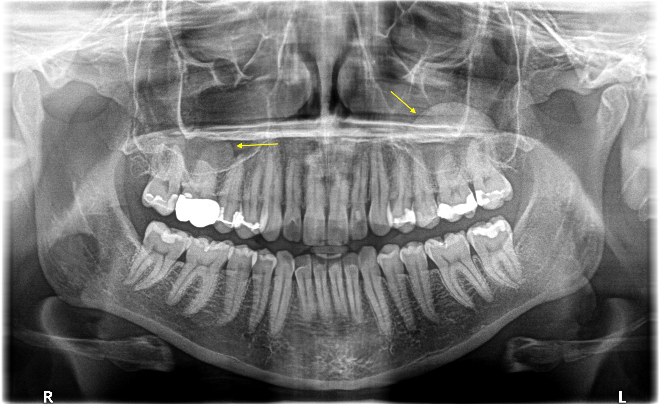 Incidental Findings Fun: 2D (Pantomographs and Periapical Radiographs)