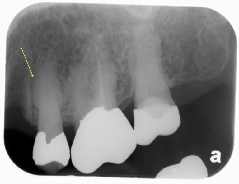 Hypercementosis Roots Radiograph Hypercementosis – Dr. G's Toothpix